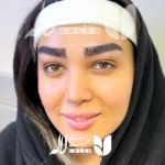 کاشت ابرو در کلینیک لاله