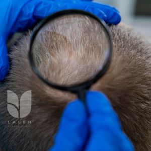 مراقبت های بعد از کاشت مو